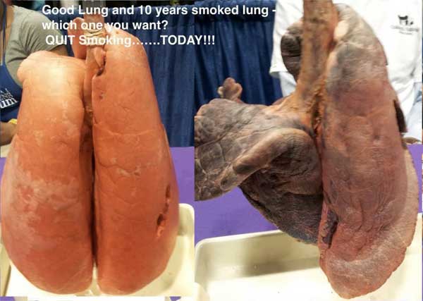 ˸����
The lungs